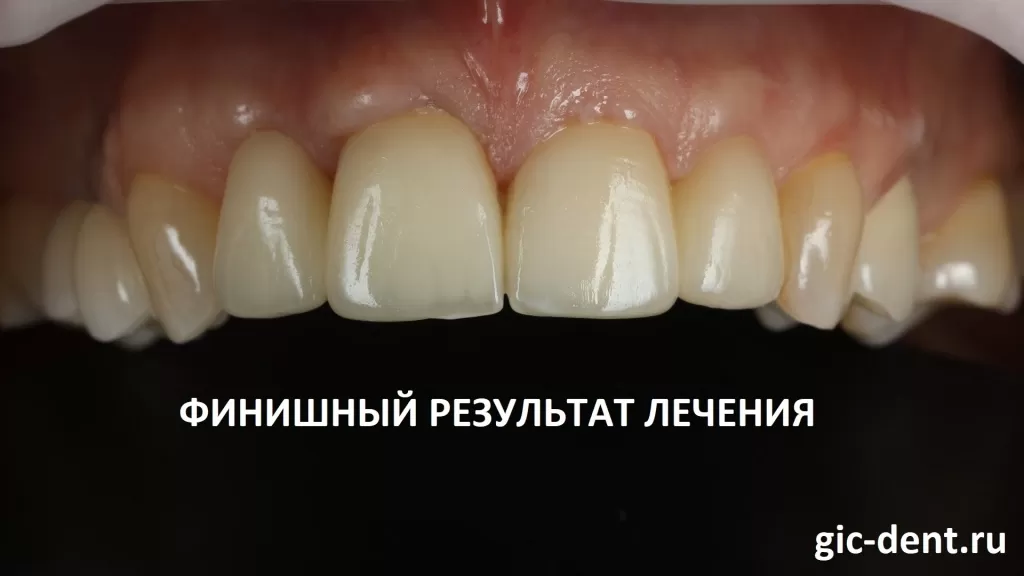 Конструкция на каркасе из диоксида циркония - надежное и эстетичное решение при имплантации и протезировании верхних передних зубов